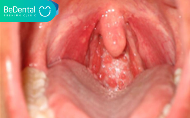Hình ảnh nổi hạt ở cuống lưỡi