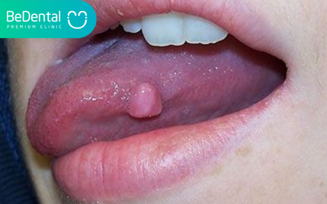 Dưới lưỡi nổi cục thịt 7 Dưới lưỡi nổi cục thịt