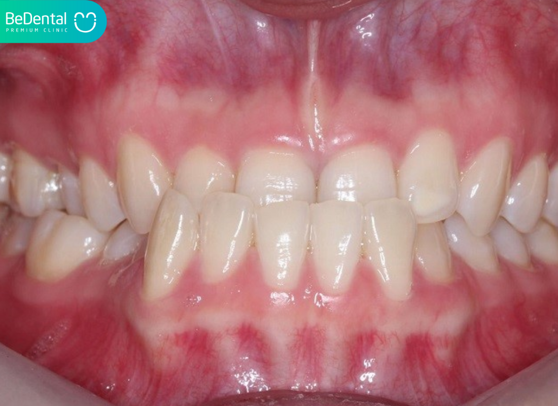 Các loại khớp cắn
