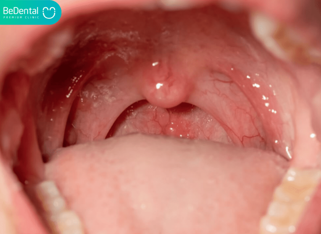 Niêm mạc miệng là gì? Nguyên nhân,dấu hiệu nhận biết và cách điều trị 2 niêm mạc miệng là gì