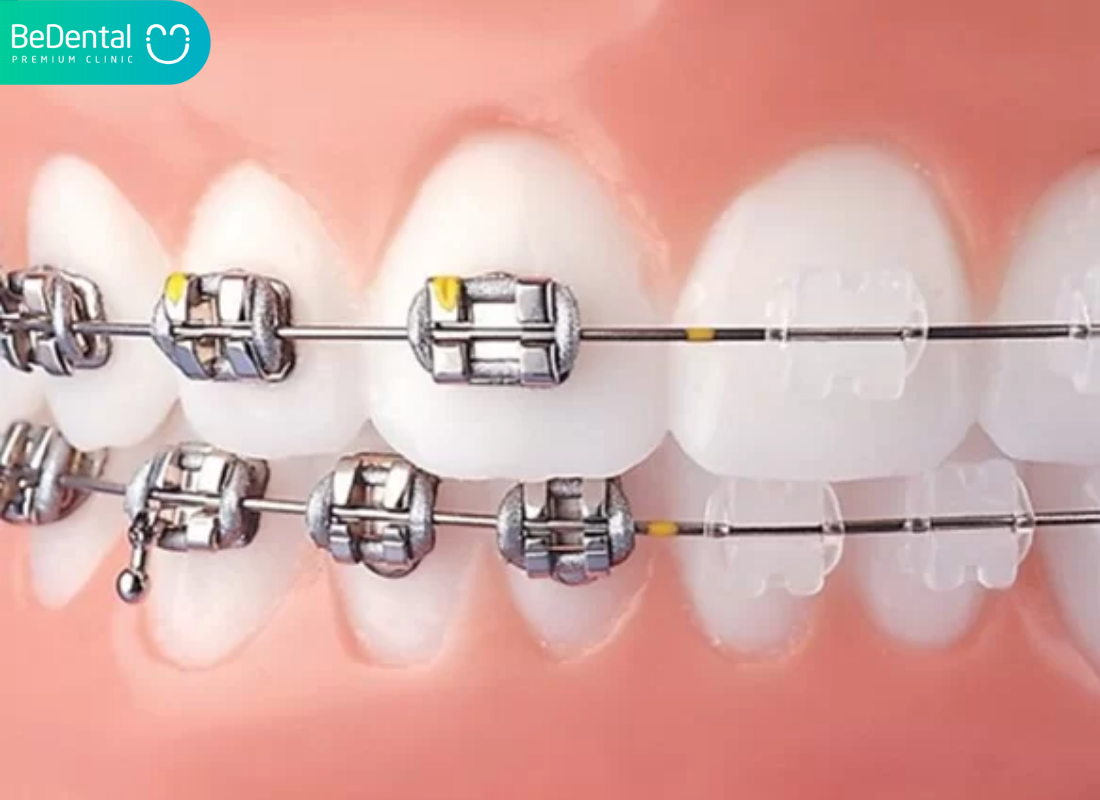 Mất răng có niềng được không?