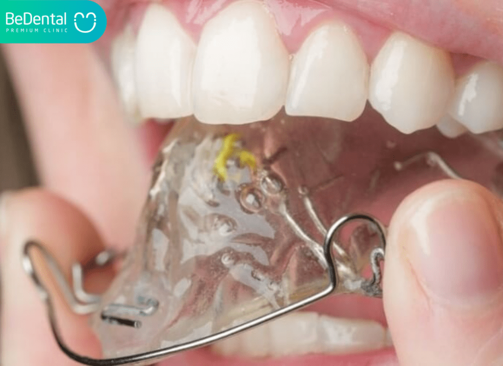 Niềng Răng Ốc Nong Rộng: Giải Pháp Tối Ưu Cho Răng Chen Chúc Ở Trẻ Em 2 niềng răng ốc nông rộng