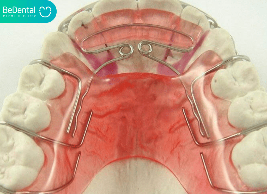 Niềng Răng Ốc Nong Rộng: Giải Pháp Tối Ưu Cho Răng Chen Chúc Ở Trẻ Em 3 nieng rang oc nong rong v2