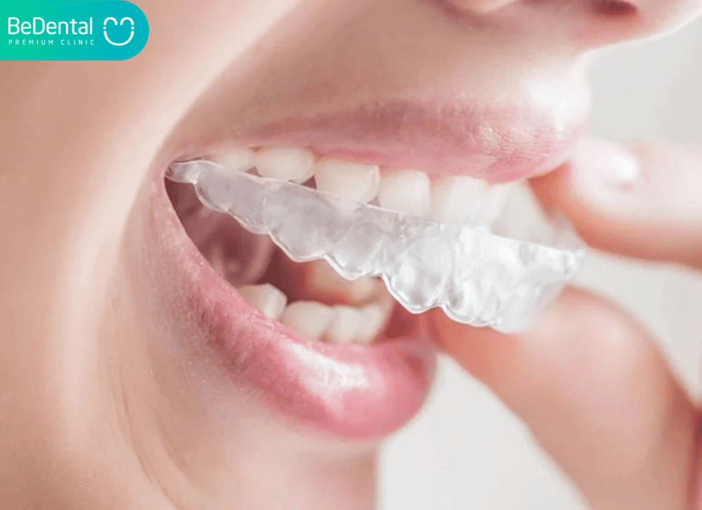 Giá Invisalign