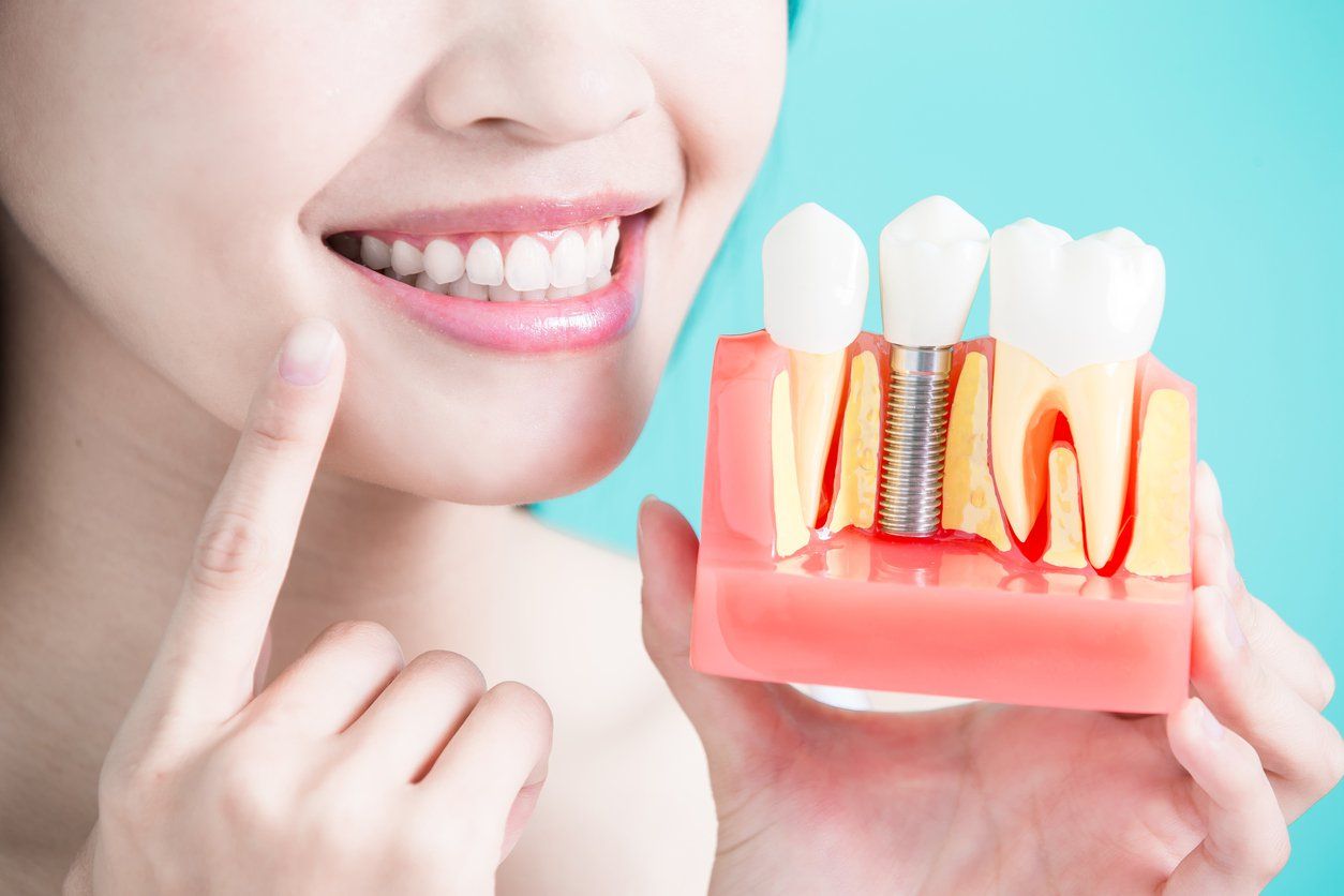 Cách trồng răng sứ. Cách trồng răng sứ. Cách trồng răng sứ. Cách trồng răng sứ 