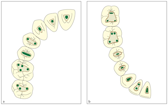 1 răng có mấy ống tủy? 