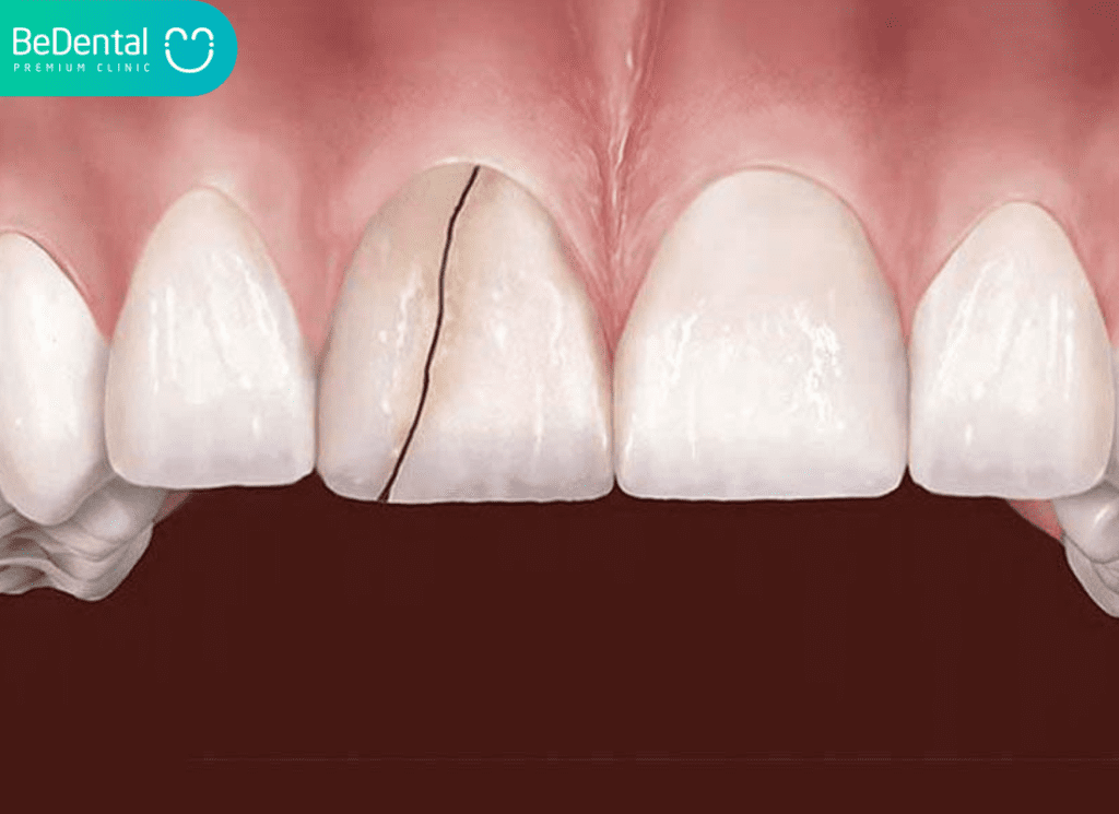 Nứt Răng Cửa: Nguyên Nhân Răng Bị Vỡ, Tác Hại Và Giải Pháp Khắc Phục 4 Cac Dang Nut Rang Cua