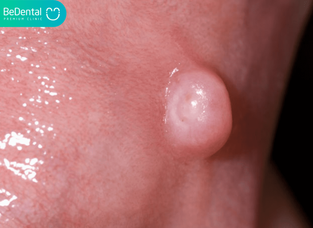 Nổi Cục Trong Miệng Không Đau: Dấu Hiệu Cảnh Báo Và Cách Xử Lý Đúng Đắn 2 Nổi cục trong miệng không đau