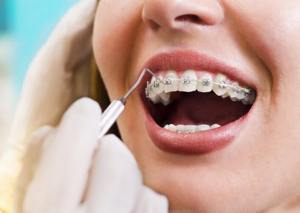Niềng răng có làm thay đổi khuôn mặt không? Giải đáp từ góc nhìn chuyên gia 9 Niềng răng có làm thay đổi khuôn mặt không? Niềng răng có làm thay đổi khuôn mặt không?