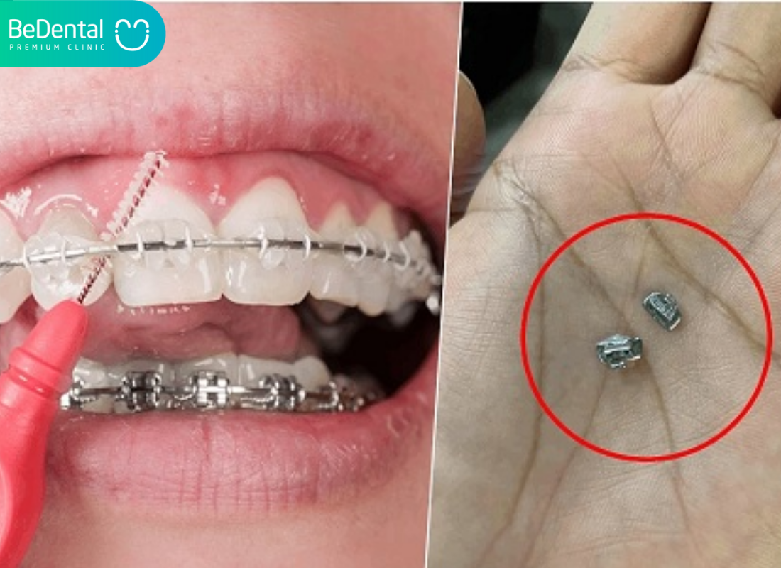 Nuốt mắc cài có sao không