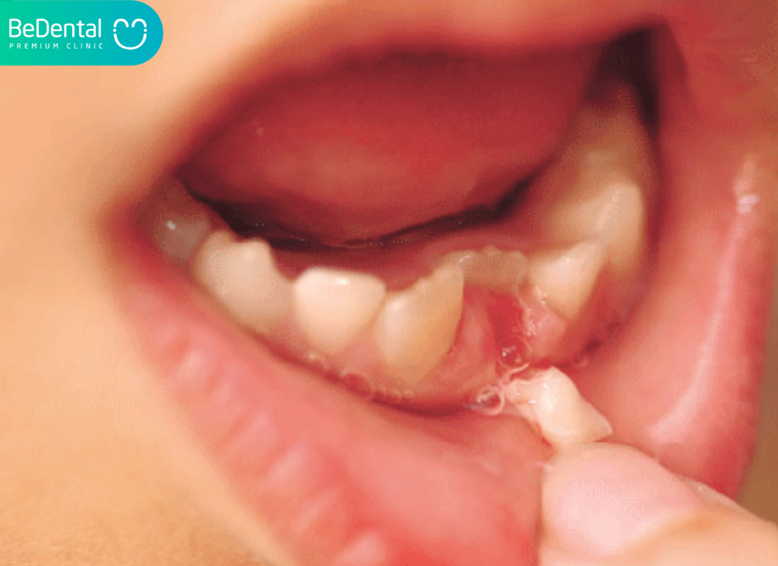 làm sao để bé thay răng đẹp