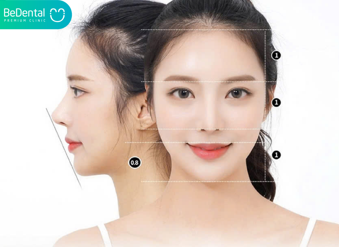 Niềng răng V line