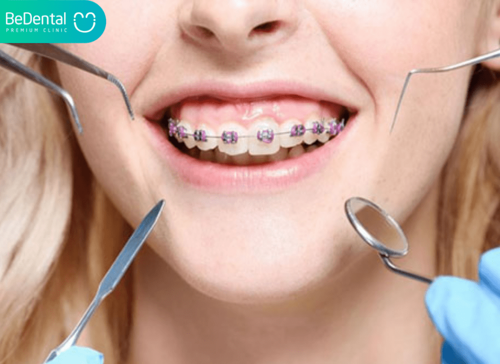 những điều cần biết khi niềng răng