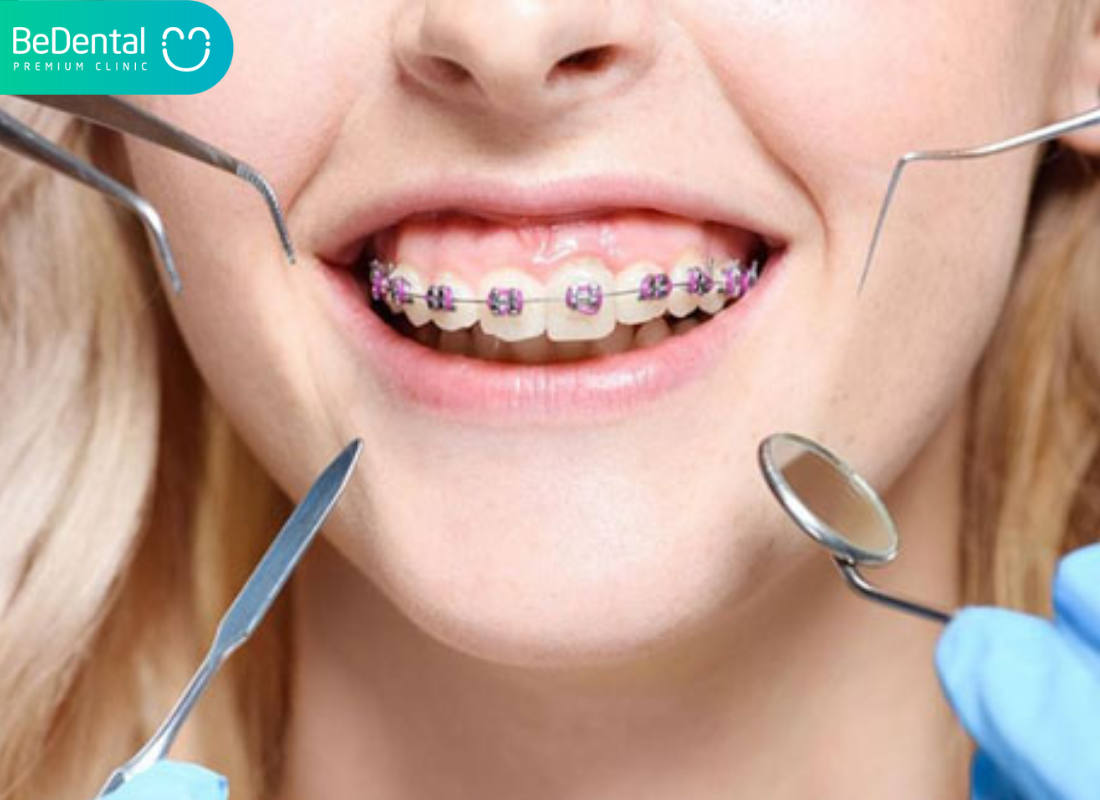 những điều cần biết khi niềng răng