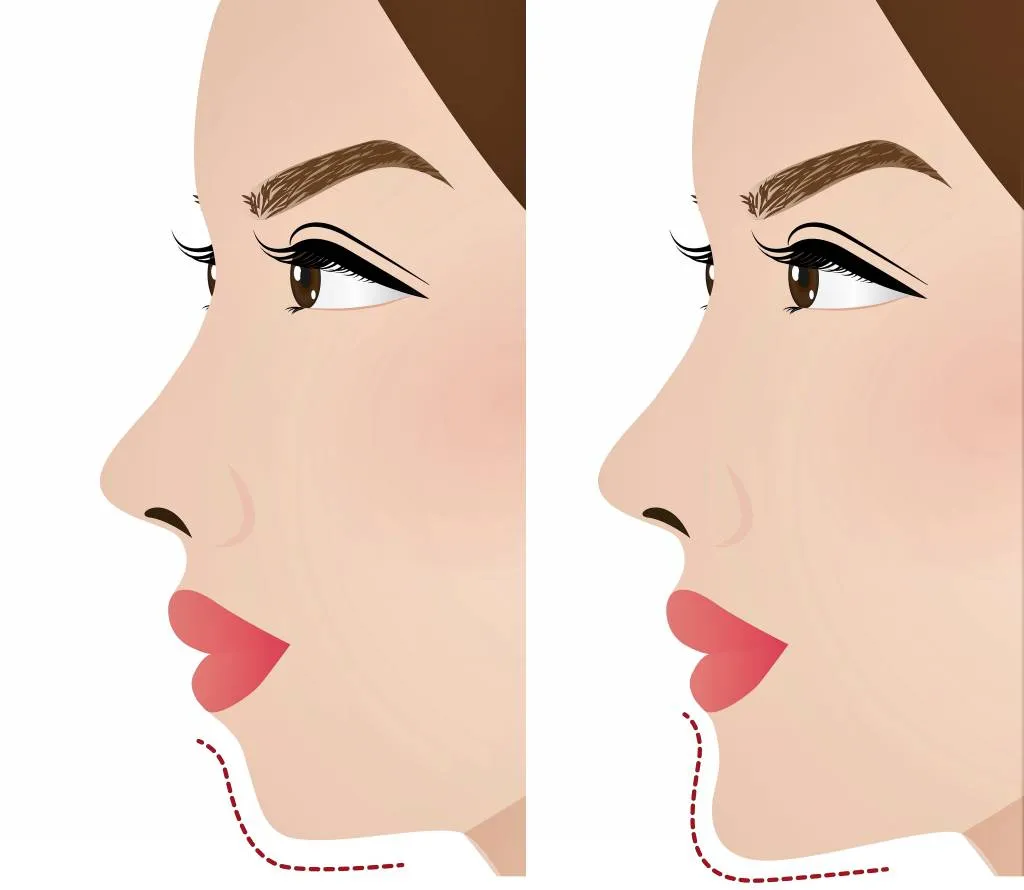 Niềng răng có làm thay đổi khuôn mặt không? Giải đáp từ góc nhìn chuyên gia 6 Nieng rang co lam thay doi khuon mat