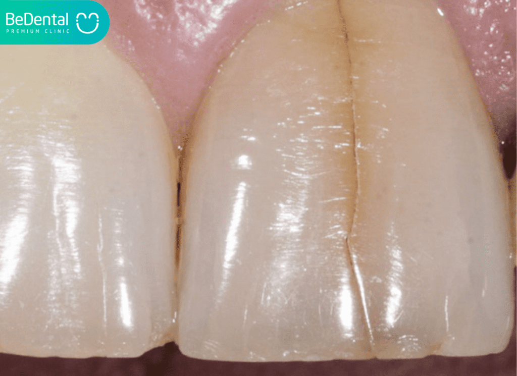 Nứt Răng Cửa: Nguyên Nhân Răng Bị Vỡ, Tác Hại Và Giải Pháp Khắc Phục 2 Nứt răng cửa