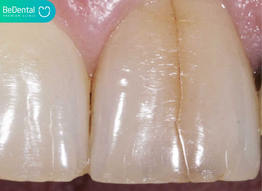 Nứt răng cửa
