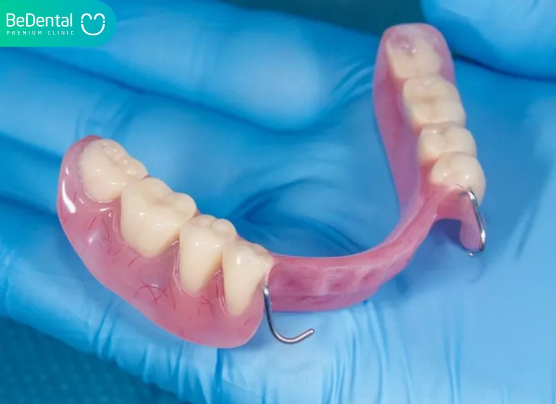 Trồng Răng Phục Hình Tháo Lắp: Tổng Quan, Ưu Nhược Điểm Và Chi Phí Dự Kiến 9 Phục hình tháo lắp