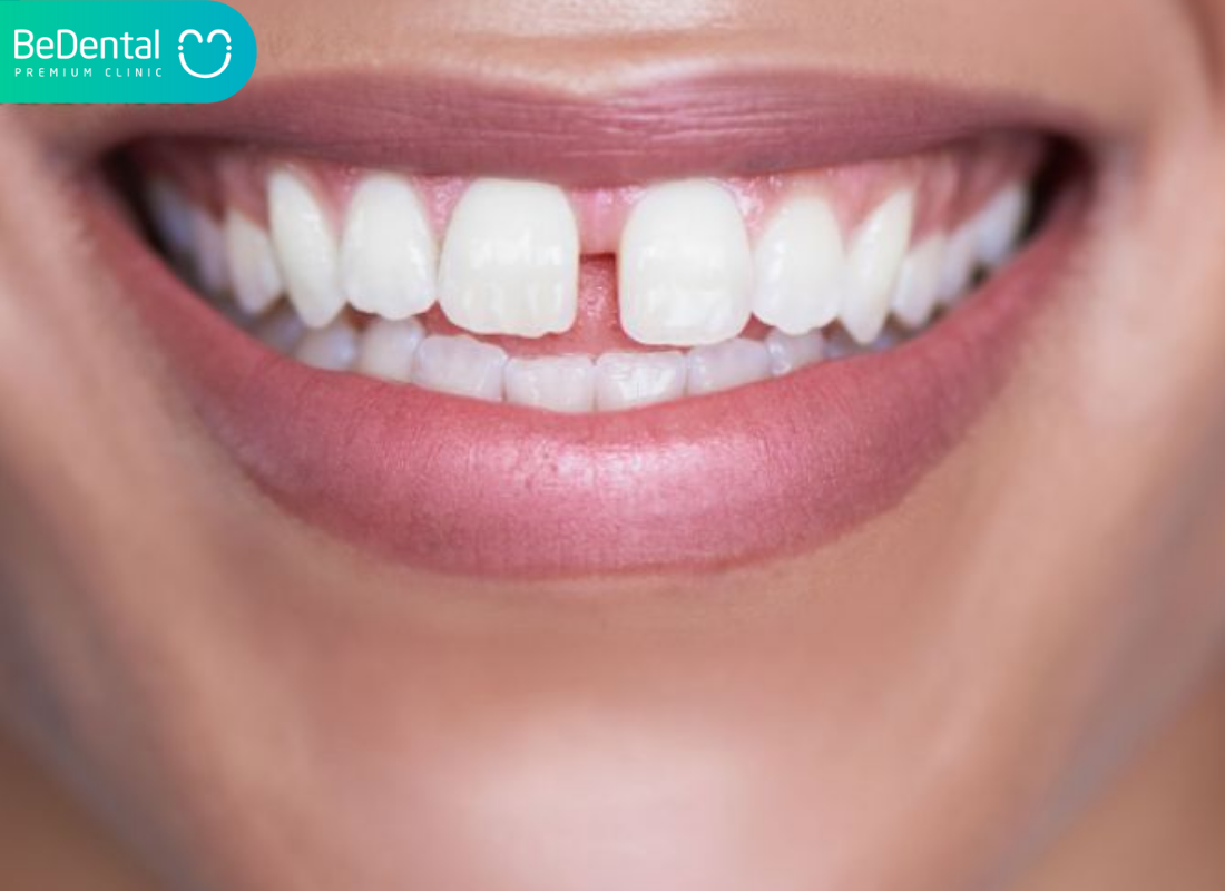Cách làm răng cửa khít lại tại nhà