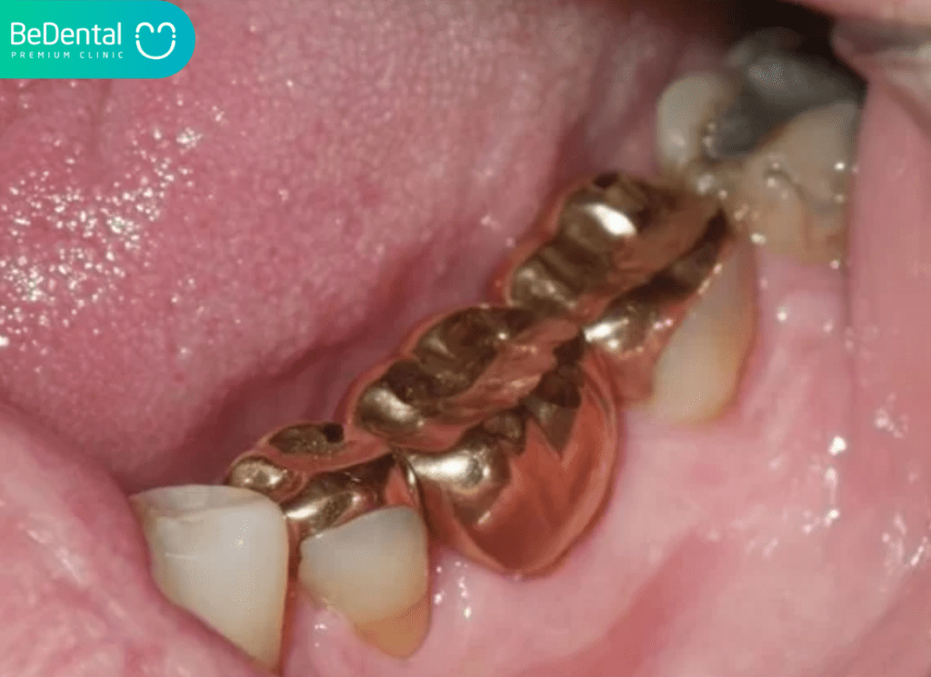 Răng Giả Vàng: Định Nghĩa, Ưu Điểm Thẩm Mỹ Và Chi Phí Cập Nhật 3 Rang gia vang 2