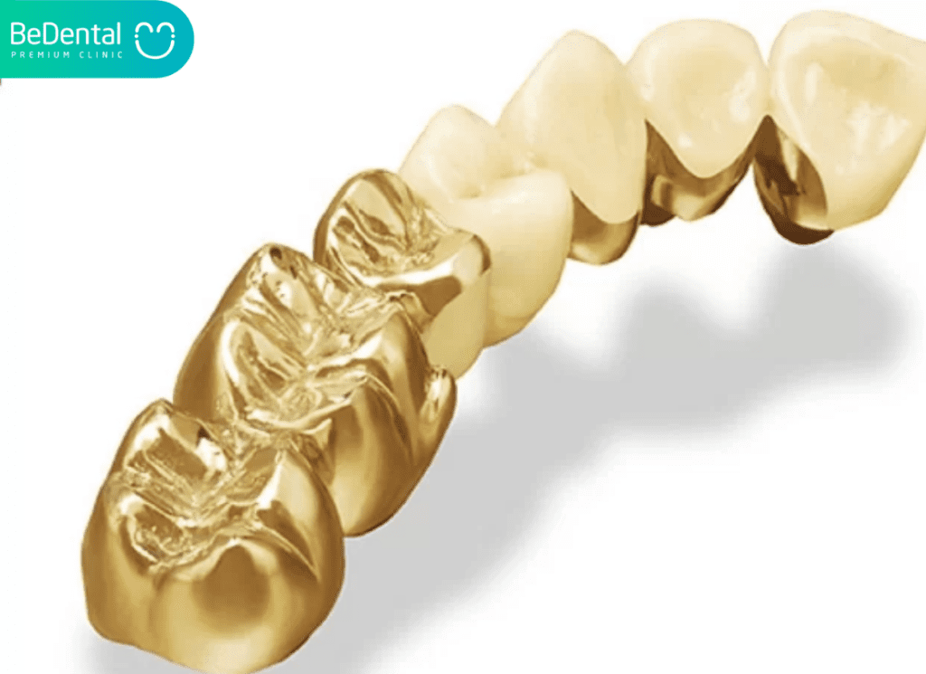 Răng Giả Vàng: Định Nghĩa, Ưu Điểm Thẩm Mỹ Và Chi Phí Cập Nhật 5 Rang gia vang 3