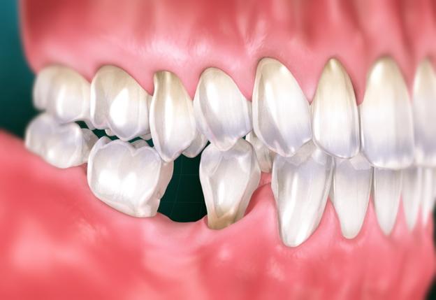 Trồng răng số 7 giá bao nhiêu? Lựa chọn đúng để khôi phục khả năng ăn nhai hiệu quả 2 Trồng răng số 7 giá bao nhiêu?