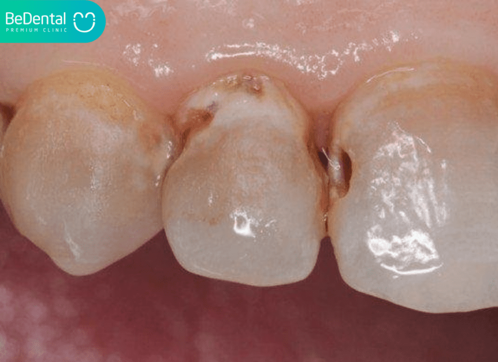 Tình Trạng Răng Bị Thủng Lỗ: Mức Độ Nghiêm Trọng, Tác Hại Và Giải Pháp Khắc Phục 2 Răng bị thủng lỗ