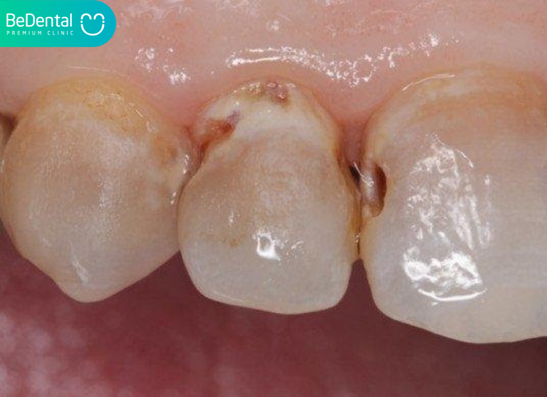 Răng bị thủng lỗ
