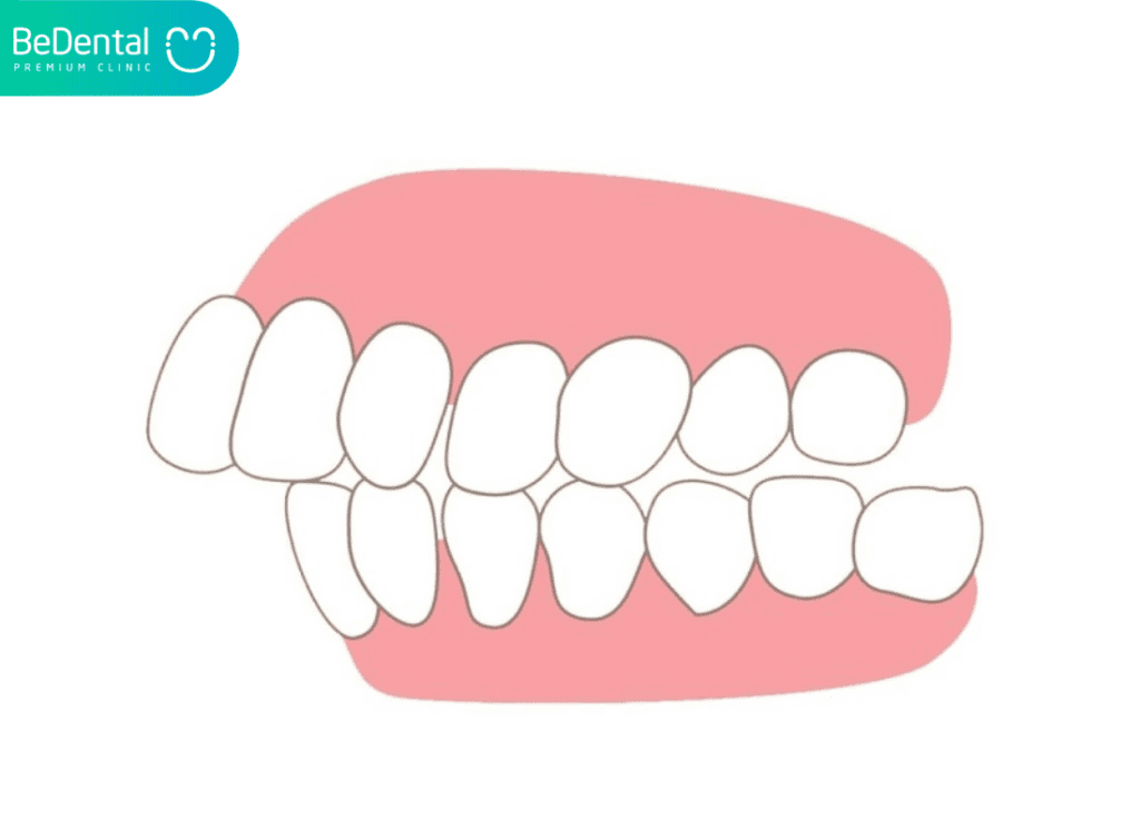 Thế Nào Là Răng Hô Nặng