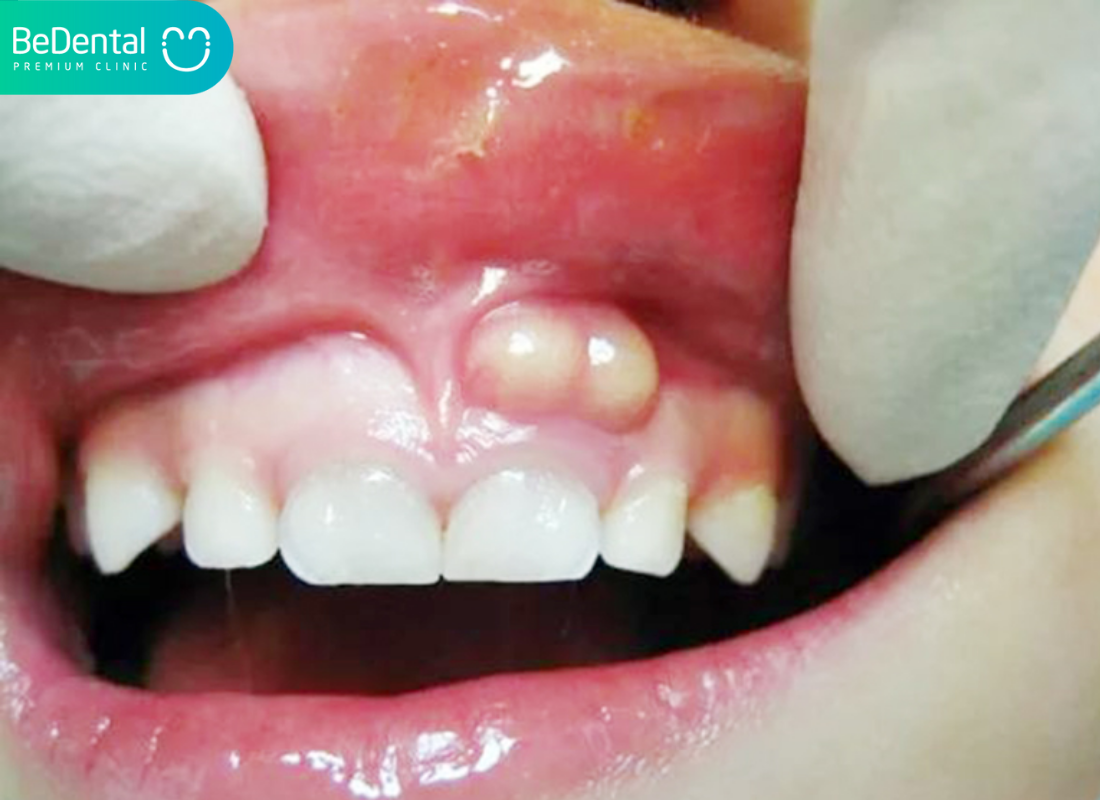 Nổi cục trong miệng không đau