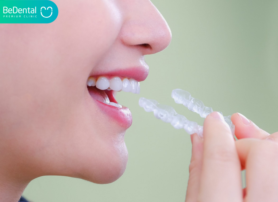 Cách Đeo Hàm Trainer Đúng Cách – Hướng Dẫn Chi Tiết Cho Người Mới 5 Uu Nhuoc Diem Chi Tiet Cua Rang Gia Silicon