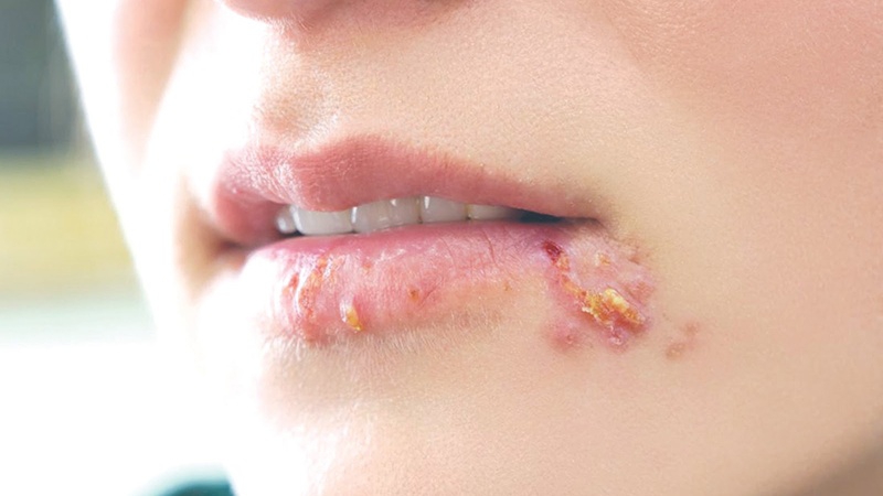 Bị Herpes Môi Kiêng Ăn Gì? Bị Herpes Môi Kiêng Ăn Gì? Bị Herpes Môi Kiêng Ăn Gì? 