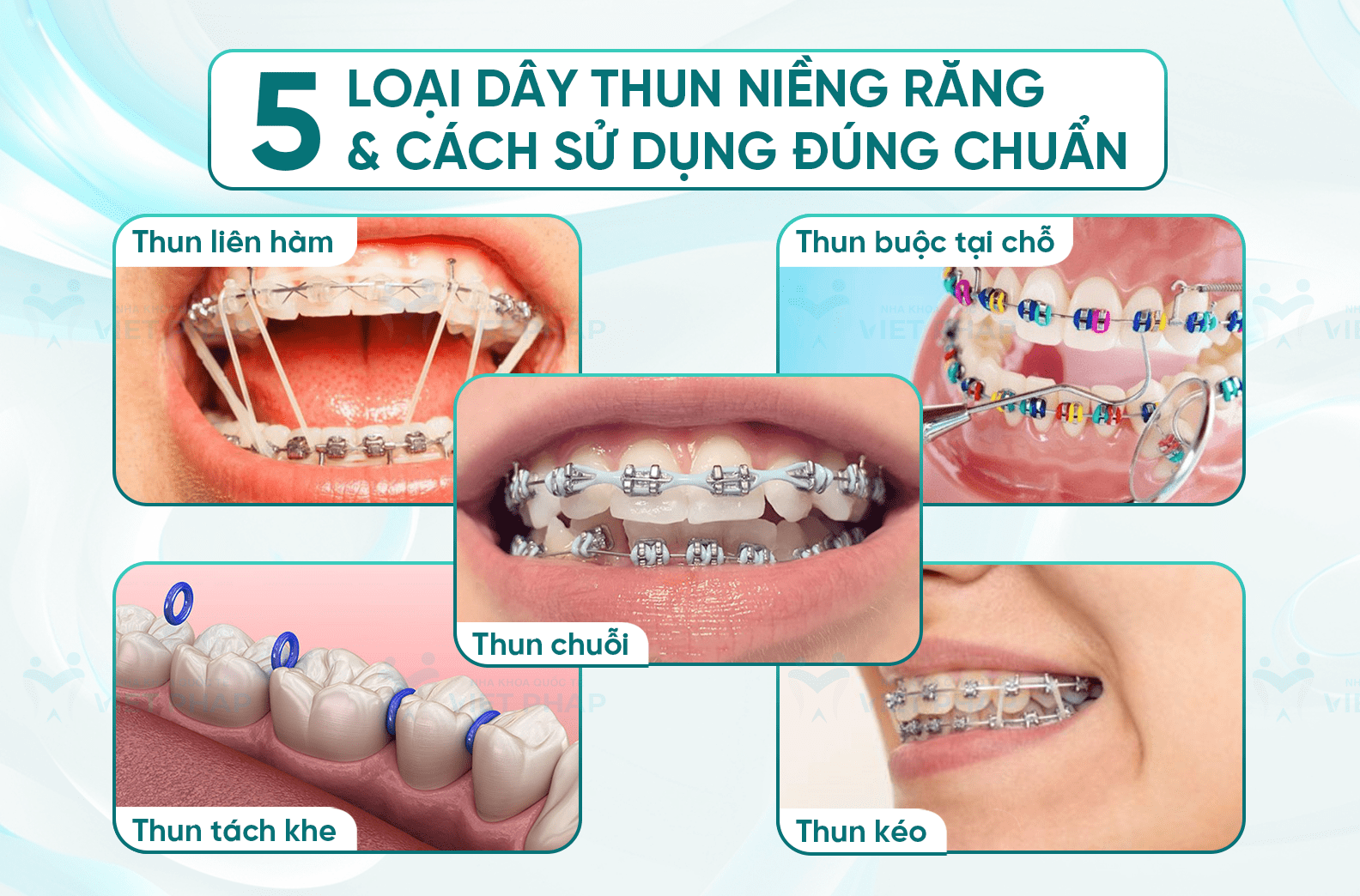 Chun Niềng Răng Là Gì? Công Dụng, Phân Loại Và Những Lưu Ý Khi Sử Dụng 3 Chun niềng răng là gì? Chun niềng răng là gì? Chun niềng răng là gì?