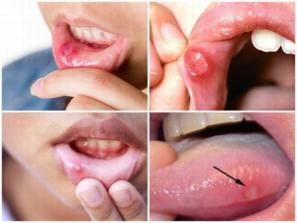  Dấu hiệu nhiệt miệng ở trẻ