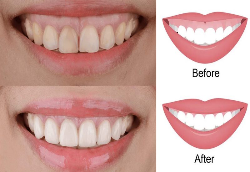 PHẪU THUẬT CƯỜI HỞ LỢI: GIẢI PHÁP TÁI TẠO NỤ CƯỜI TỰ TIN VÀ TỰ NHIÊN 5 cat loi