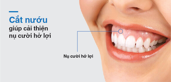 PHẪU THUẬT CƯỜI HỞ LỢI: GIẢI PHÁP TÁI TẠO NỤ CƯỜI TỰ TIN VÀ TỰ NHIÊN 4 cat nuou