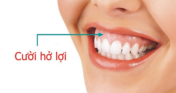 Đánh lún răng bằng dây cung: Kỹ thuật chỉnh nha giúp hạ thấp răng đúng vị trí 3 cuoi ho loi 1