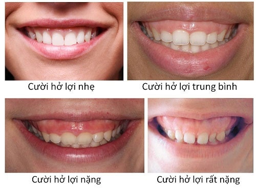 PHẪU THUẬT CƯỜI HỞ LỢI: GIẢI PHÁP TÁI TẠO NỤ CƯỜI TỰ TIN VÀ TỰ NHIÊN 3 cuoi ho loi la gi