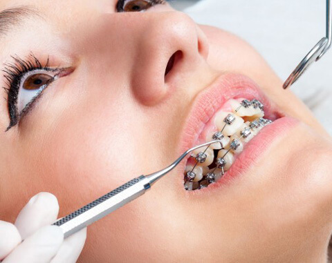 Đánh lún răng bằng dây cung: Kỹ thuật chỉnh nha giúp hạ thấp răng đúng vị trí 2 Đánh lún răng bằng dây cung. Đánh lún răng bằng dây cung. Đánh lún răng bằng dây cung