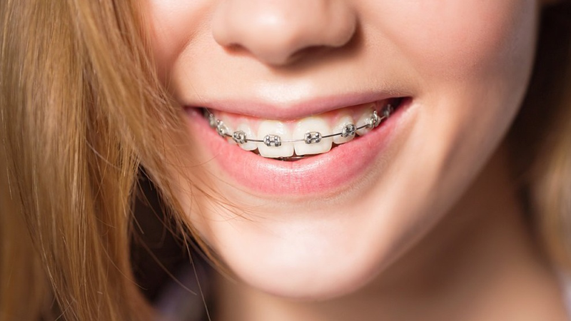 Đánh lún răng bằng dây cung: Kỹ thuật chỉnh nha giúp hạ thấp răng đúng vị trí 7 Đánh lún răng bằng dây cung. Đánh lún răng bằng dây cung. Đánh lún răng bằng dây cung
