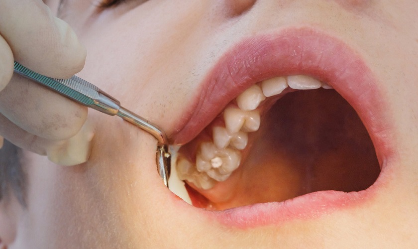 Dấu hiệu mọc răng khôn: Nhận biết sớm để tránh biến chứng nguy hiểm 2 Dấu hiệu mọc răng khôn. Dấu hiệu mọc răng khôn. Dấu hiệu mọc răng khôn