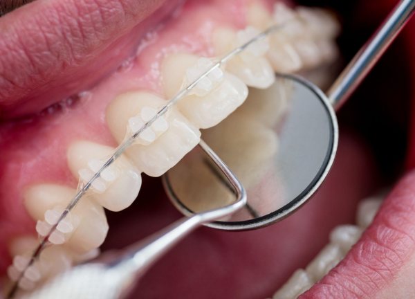 Dây Cung Niềng Răng Là Gì? Vai Trò Quan Trọng Trong Niềng Răng 7 day cung niti