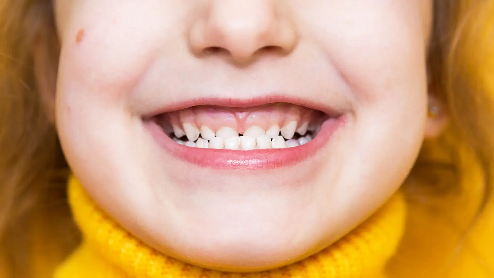 Sẽ móm là gì? Nguyên nhân, dấu hiệu và cách khắc phục hiệu quả 3 dieu tri mom cho tre 2