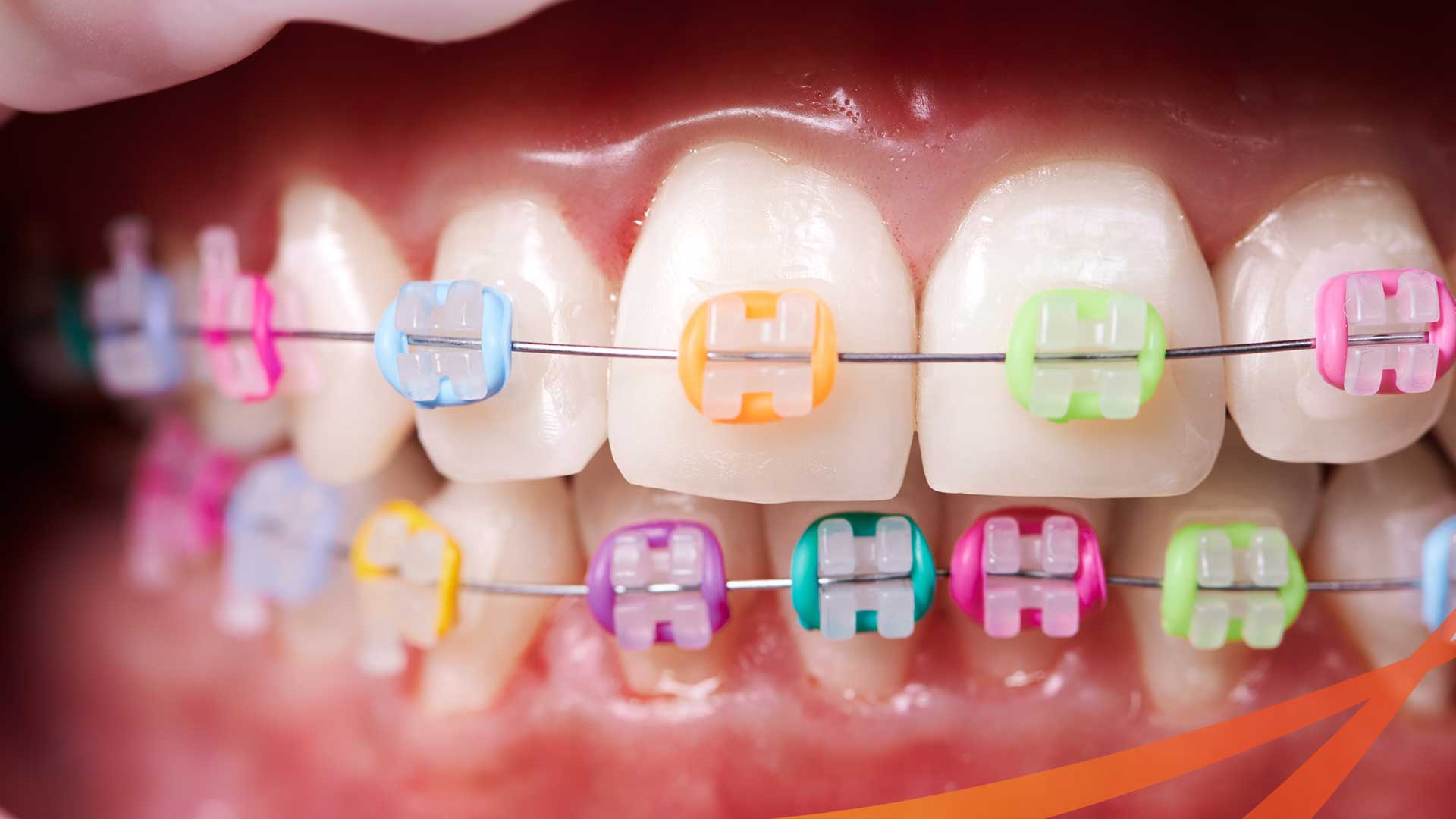Chun Niềng Răng Là Gì? Công Dụng, Phân Loại Và Những Lưu Ý Khi Sử Dụng 4 giai dap nieng rang chun mau nao dep nhat k Kpjr 1661910239 d2741a2f4e