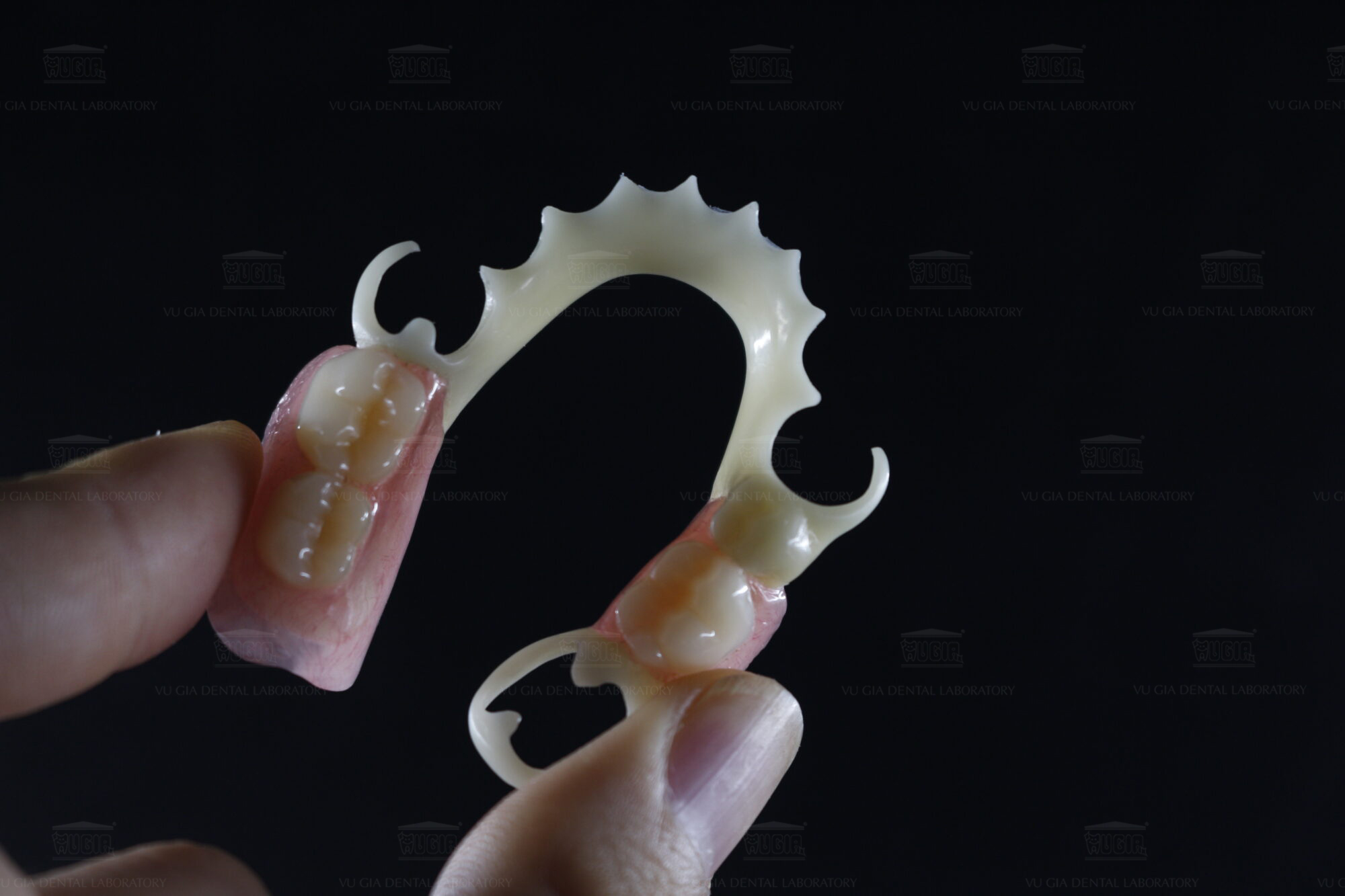 Hàm khung – Giải pháp phục hình răng mất hiệu quả và bền vững 3 Hàm khung là gì?