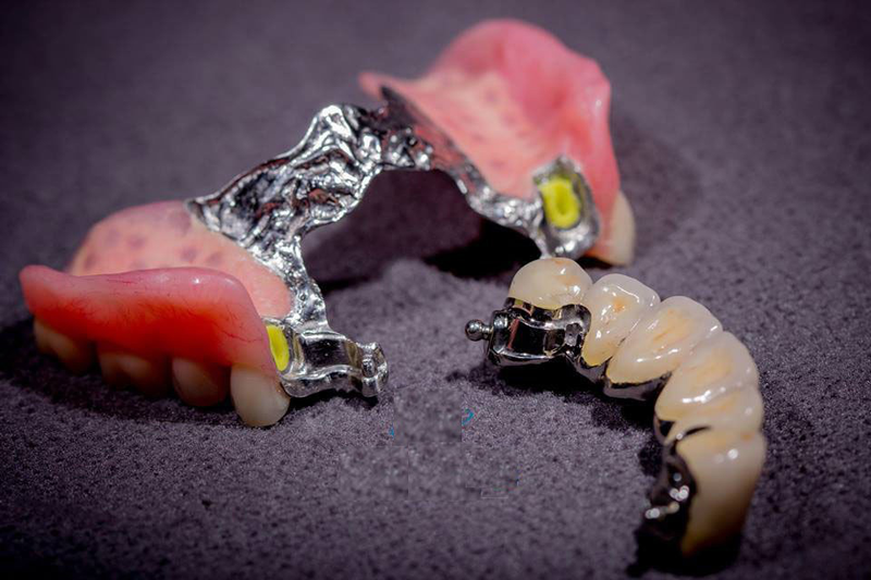 Hàm khung – Giải pháp phục hình răng mất hiệu quả và bền vững 4 ham khung lien ket la gi ham khung lien ket chia thanh may loai 2 a4648acc5f