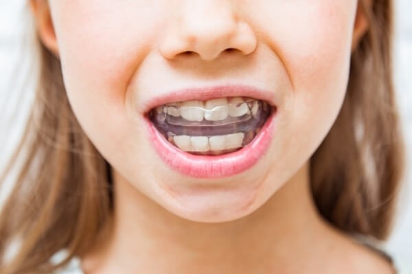 Trainer Braces in Vietnam. Trainer Braces in Vietnam. Trainer Braces in Vietnam. Trainer Braces in Vietnam