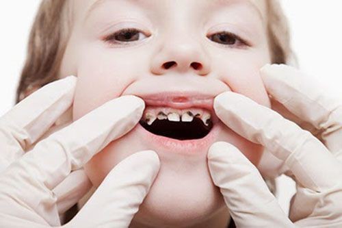 Bắt sâu răng qua mắt: Công nghệ chẩn đoán sớm bằng hình ảnh có khả thi không? 8 image 20240328081737 1