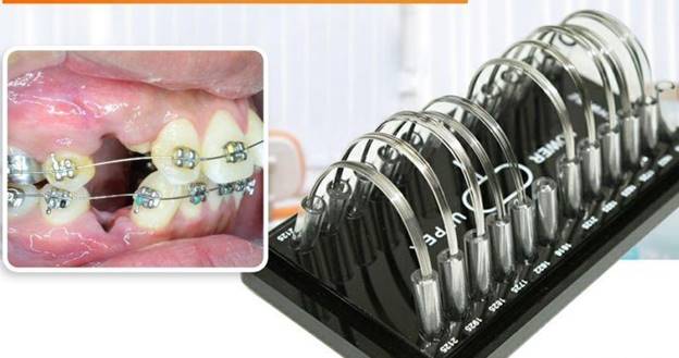 Dây Cung Niềng Răng Là Gì? Vai Trò Quan Trọng Trong Niềng Răng 2 Dây cung niềng răng là gì?