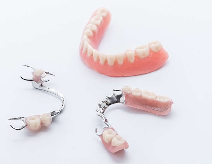 Hàm khung – Giải pháp phục hình răng mất hiệu quả và bền vững 2 Hàm khung là gì?